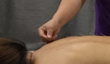 Needling